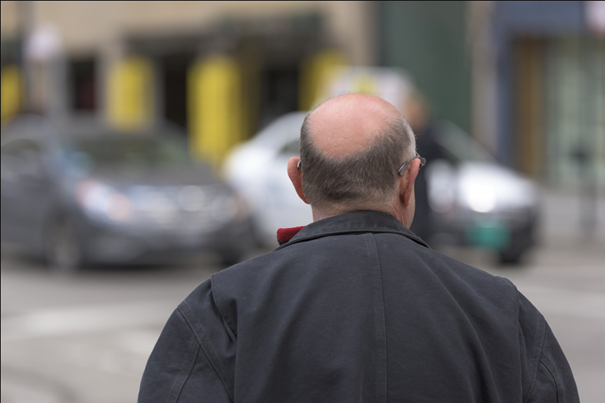 Traiter et favoriser la repousse naturelle des cheveux par une petite intervention chirurgicale